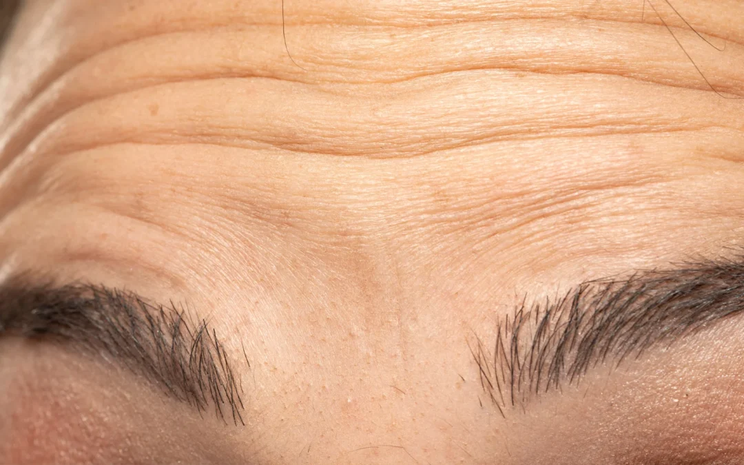 What Is a Brow Lift & How Much Does it Cost? UK Guide