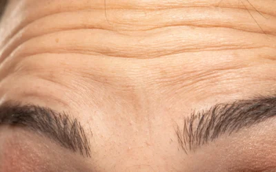 What Is a Brow Lift & How Much Does it Cost? UK Guide