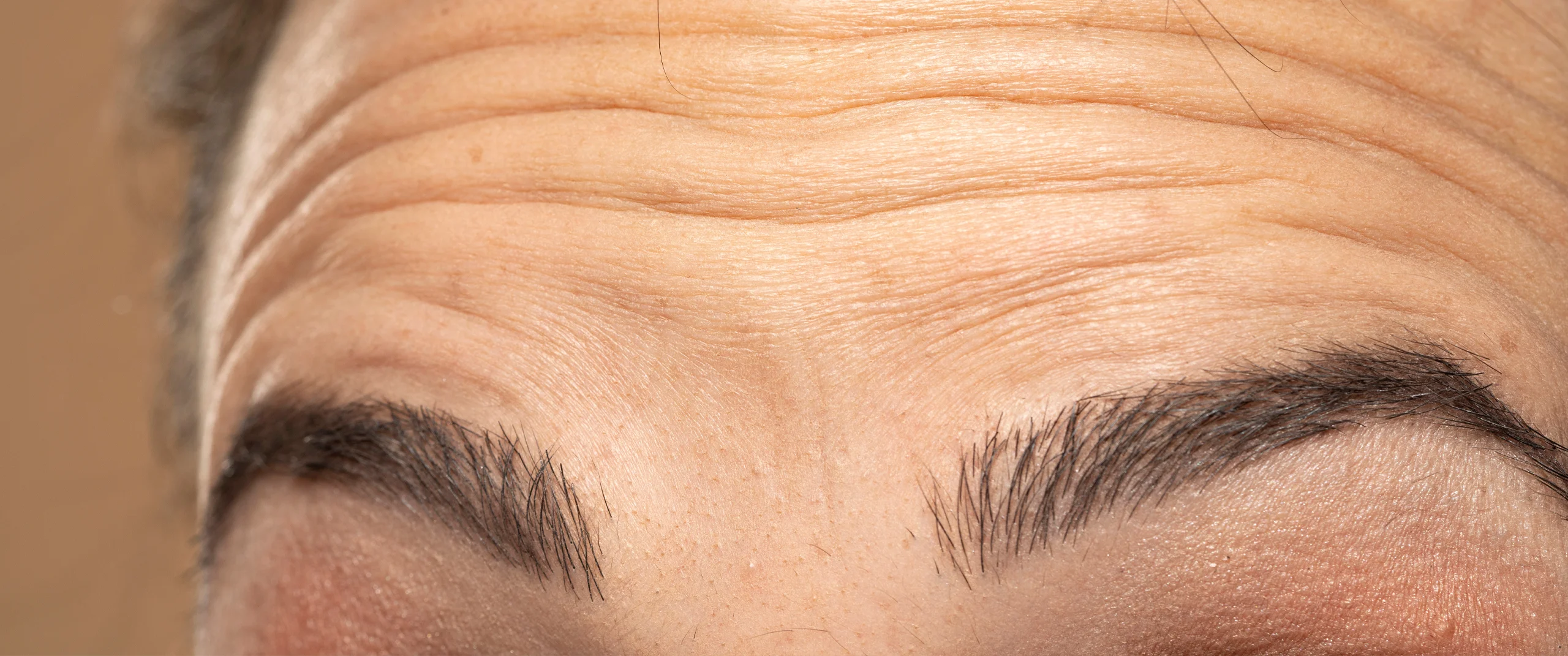 Brow Lift brow lift
