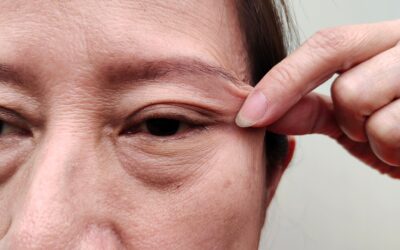 Why do many facelift patients sometimes require a browlift?